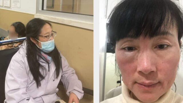 Gambar di sebelah kiri menampilkan Lydia, yang diserang di sebuah stan informasi di Flushing, New York. (Global Tuidang Center) Gambar di sebelah kanan menunjukkan Chunping, yang wajahnya mengalami memar parah dan bengkak akibat serangan oleh seorang sopir bus di luar British Museum. (NTD.com)
