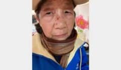 Lü Anmin, seorang wanita berusia 73 tahun, mengalami luka memar yang nyata pada bagian wajah akibat insiden penyerangan yang terjadi pada 25 Maret 2026 di Flushing, New York. (Global Tuidang Center)