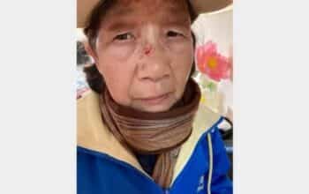 Lü Anmin, seorang wanita berusia 73 tahun, mengalami luka memar yang nyata pada bagian wajah akibat insiden penyerangan yang terjadi pada 25 Maret 2026 di Flushing, New York. (Global Tuidang Center)